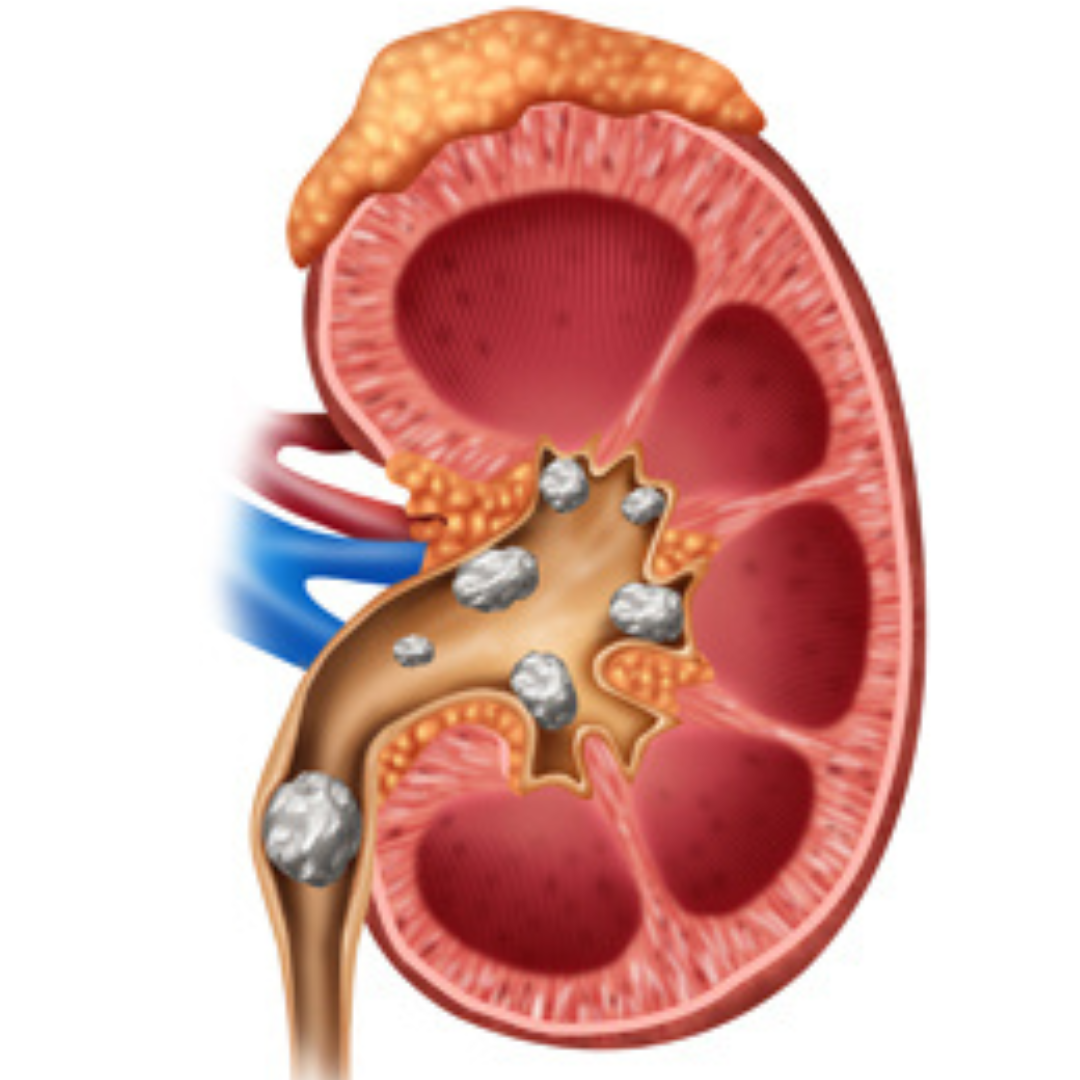 Stones resistant to other treatments (ESWL/URS)
