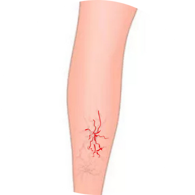 Saphenous Varicose Veins