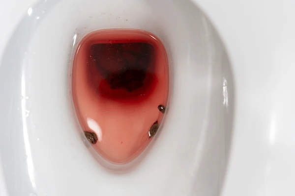 Bright red bleeding during stool