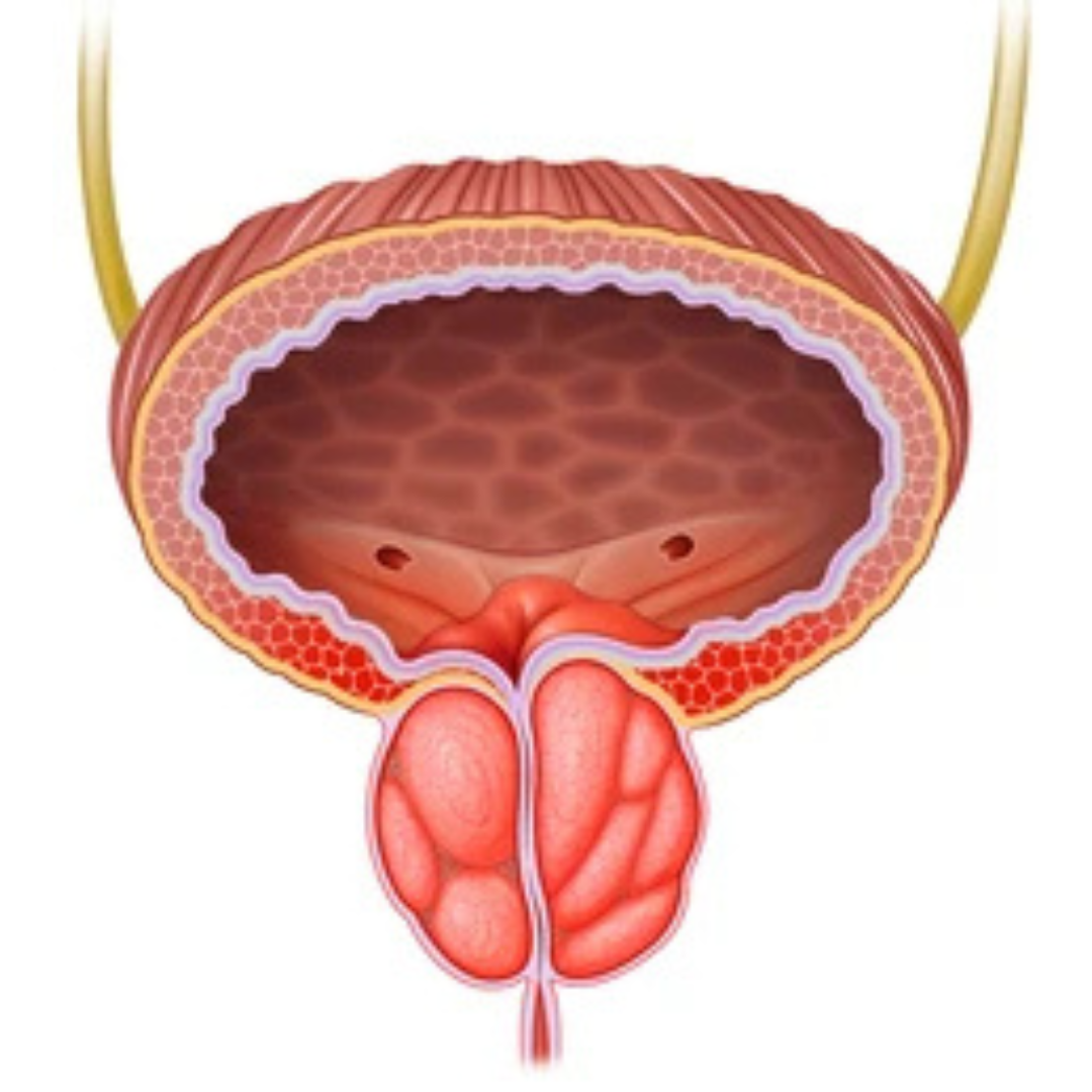Urinary tract infections (UTIs)