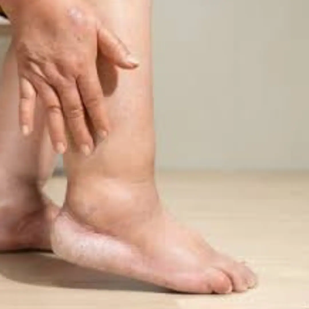 Swollen ankles