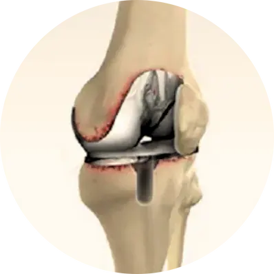 Revision Joint Replacement