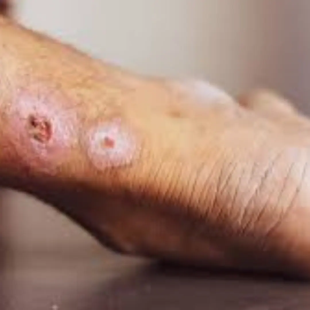 Non-healing ulcer of the leg