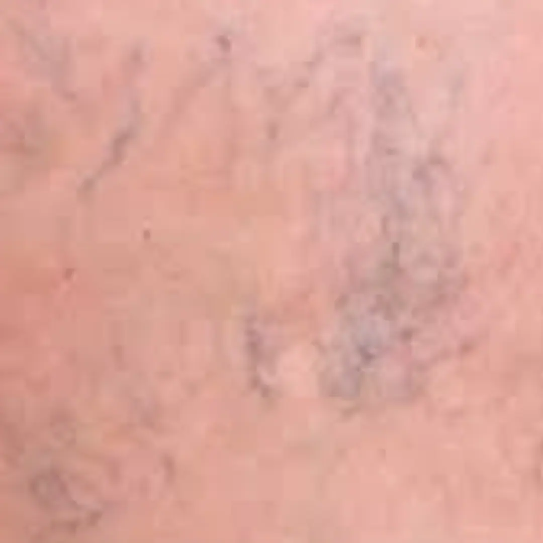 Dark purple-colored veins