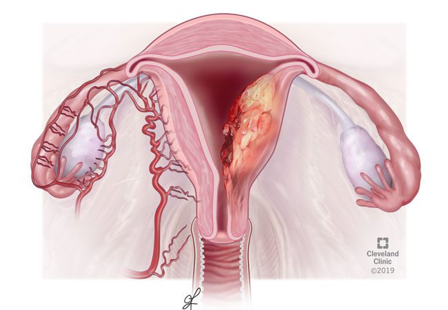 Cancer of the uterus, cervix, or ovaries