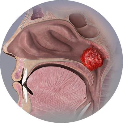 Adenoid hypertrophy