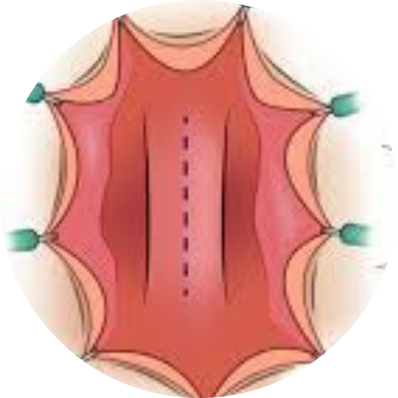 Substitution Urethroplasty