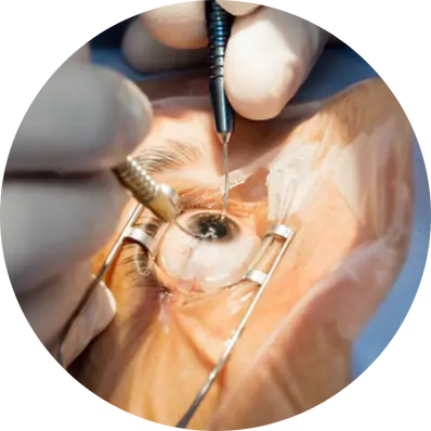 Phacoemulsification (Phaco)