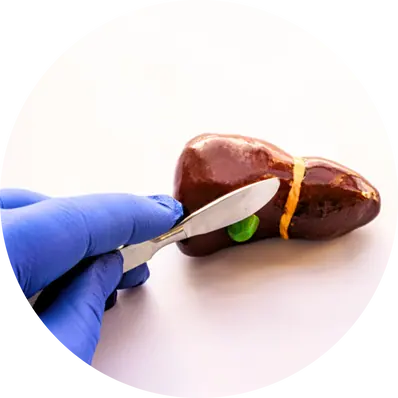 Open Cholecystectomy