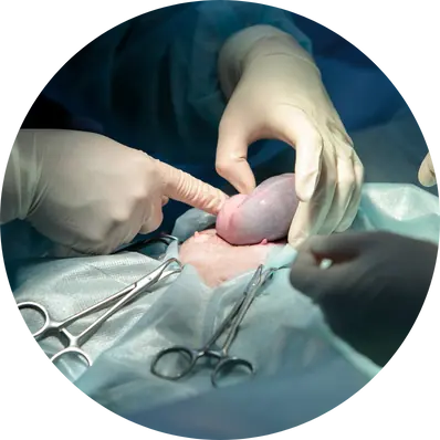 Open (Laparotomy) Cystectomy