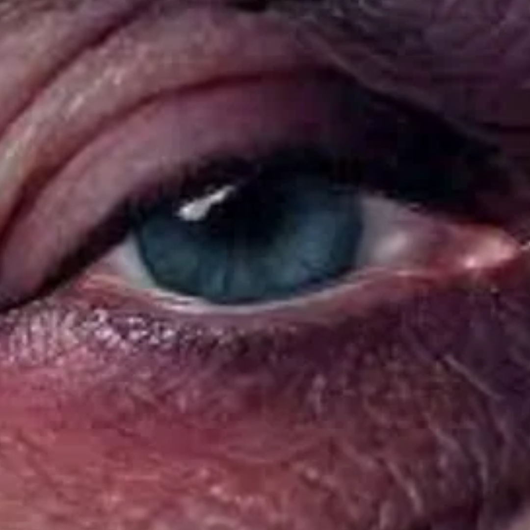 Pain, swelling, and bruising around the nose and eyes
