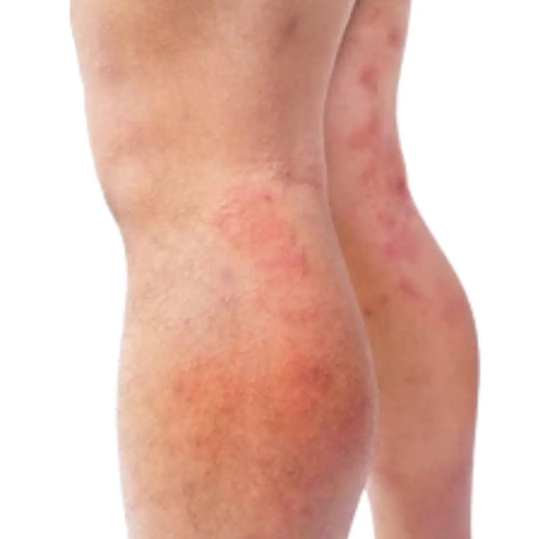 Bleeding from leg veins