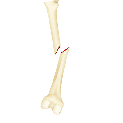 Comminuted fracture