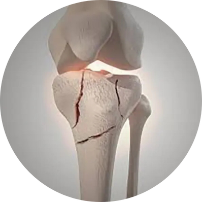Septal fracture
