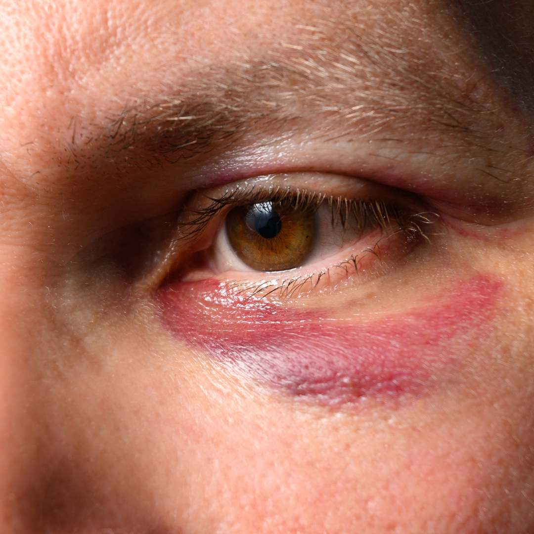 Painful or infected corneal ulcer scar