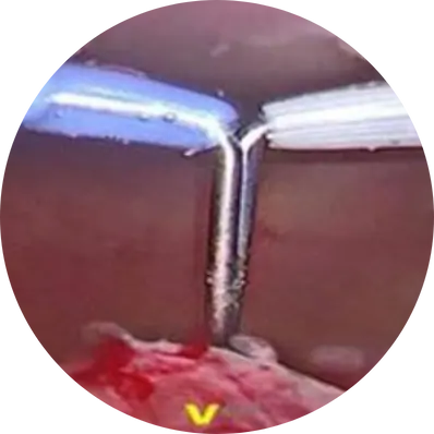 Bipolar TURP