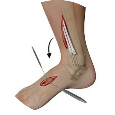 Tendon Transfers