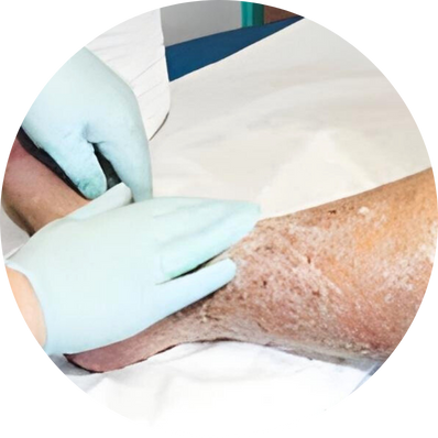Mechanical Debridement