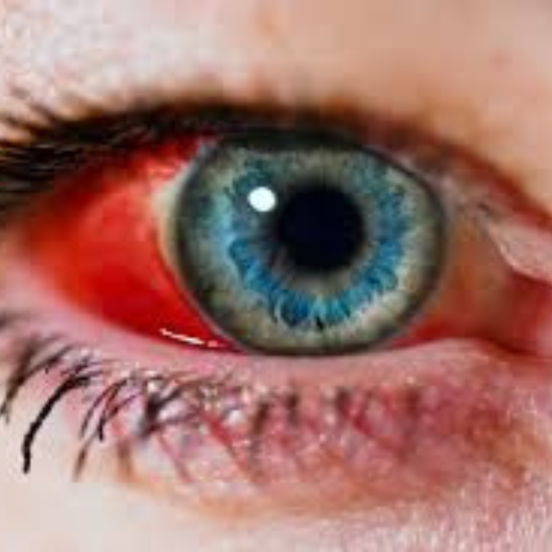 Eye injury with internal bleeding