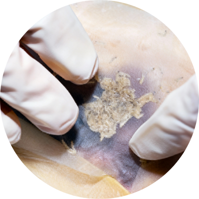 Biological Debridement (Maggot Therapy)