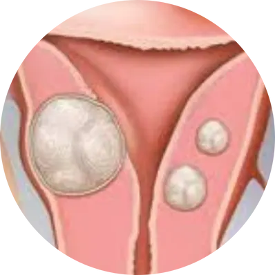 Radical hysterectomy