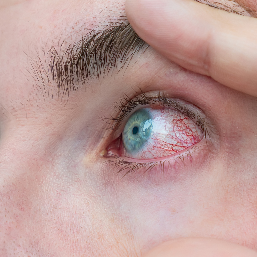 Corneal swelling or decompensation