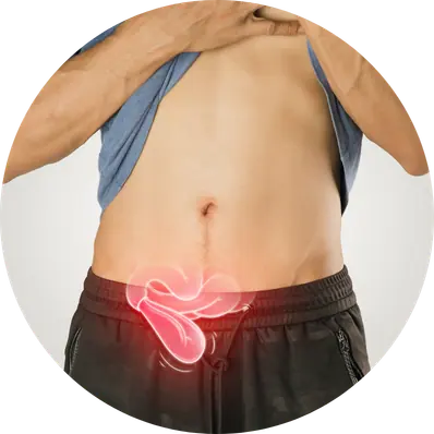 Inguinal Hernia