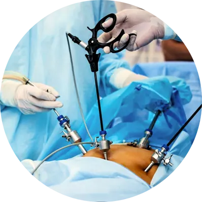 Laparoscopic Cholecystectomy