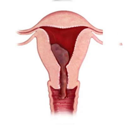 Incomplete miscarriage