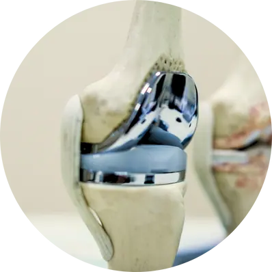 Total Joint Replacement