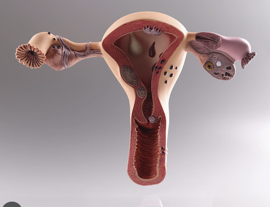 Failed medical treatment for abnormal uterine bleeding