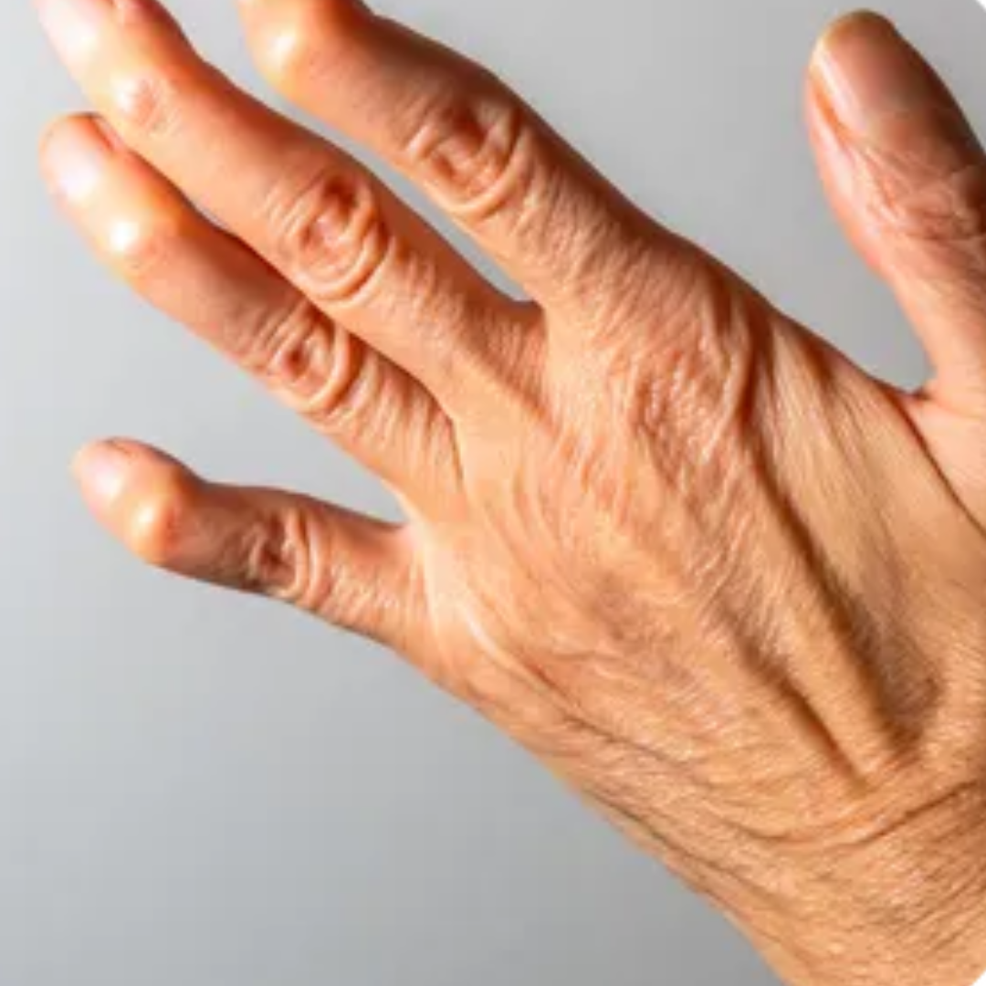 Finger stiffness, especially in the morning