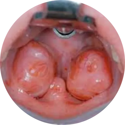 Partial tonsillectomy