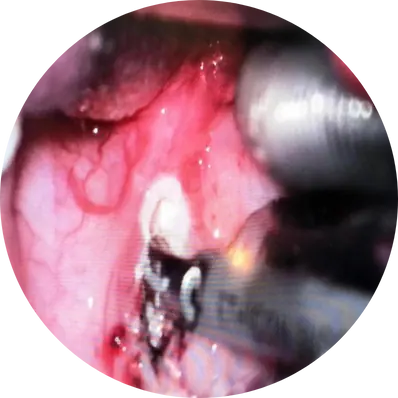 Harmonic scalpel tonsillectomy