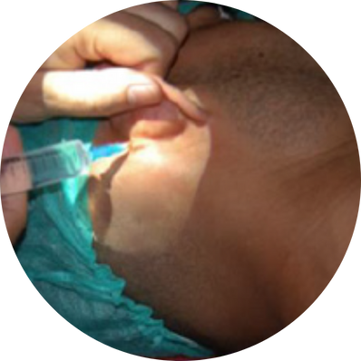 Modified Radical Mastoidectomy