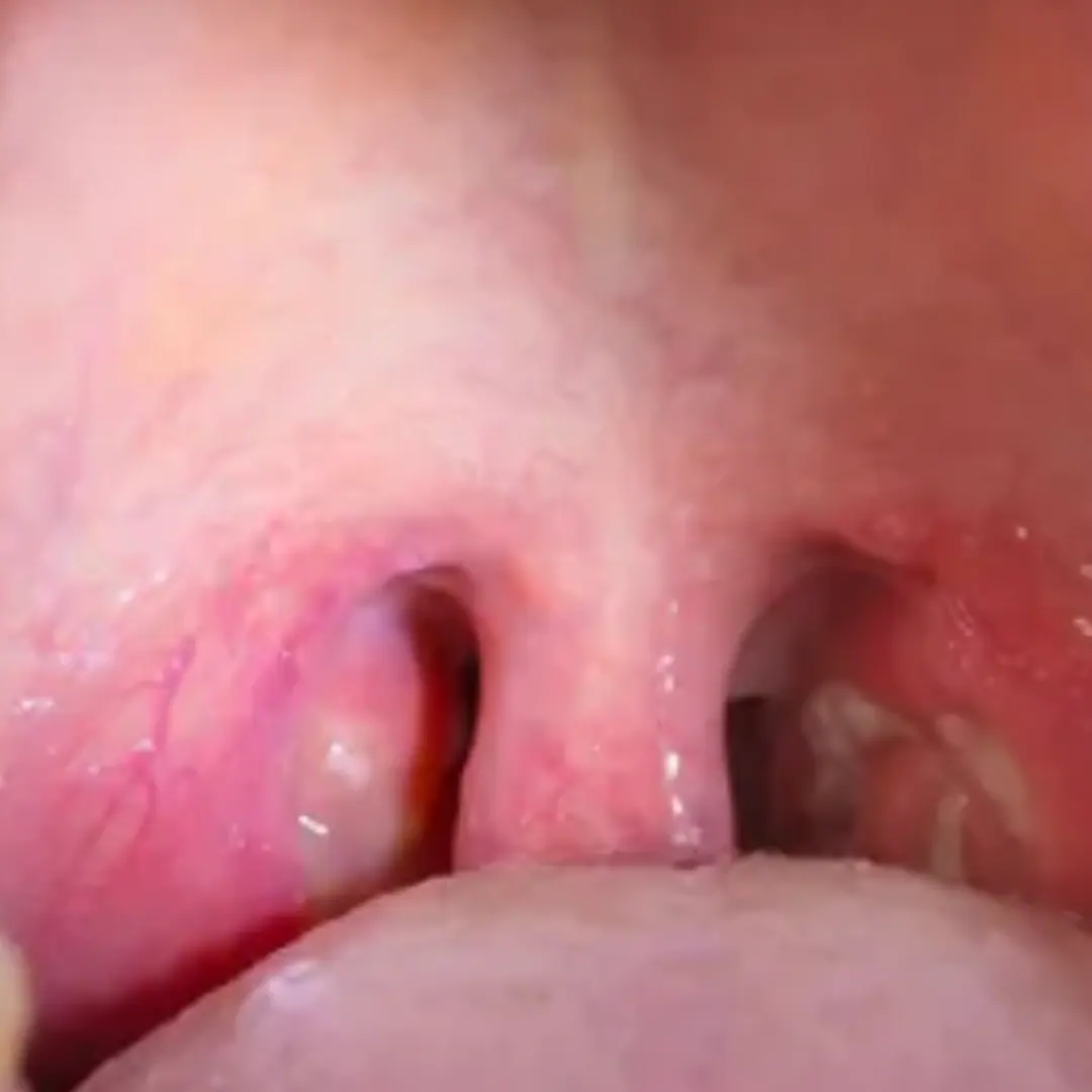 Obstructive sleep apnea
