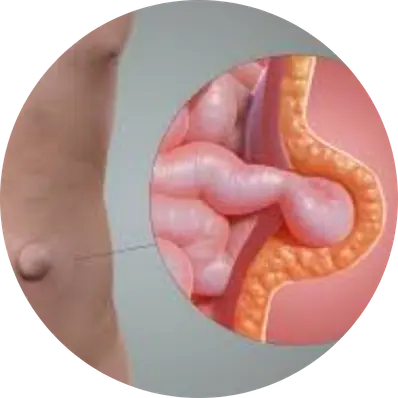 Umbilical Hernia