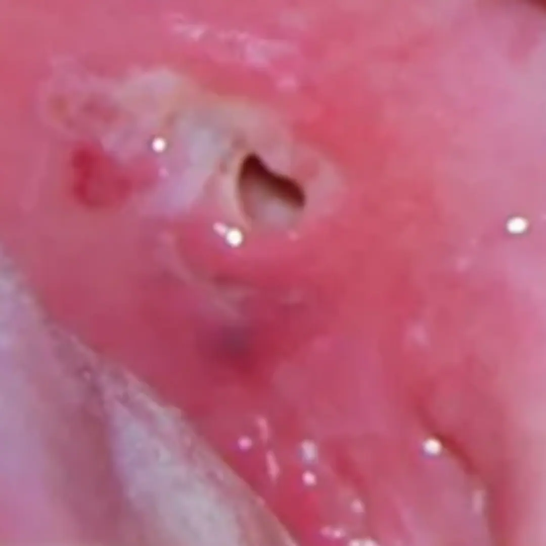 Enlarged tonsils causing breathing difficulty