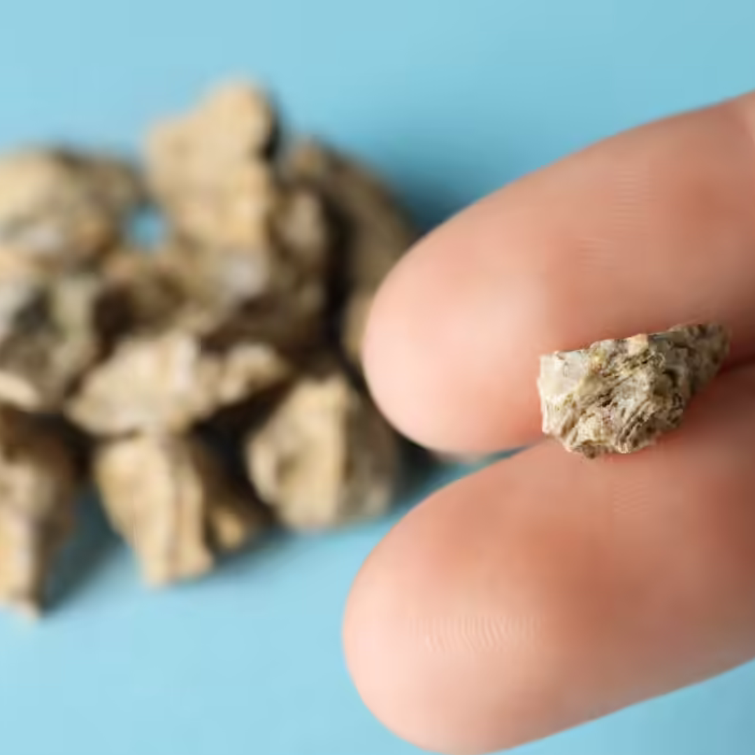 Large kidney stones (>2 cm)
