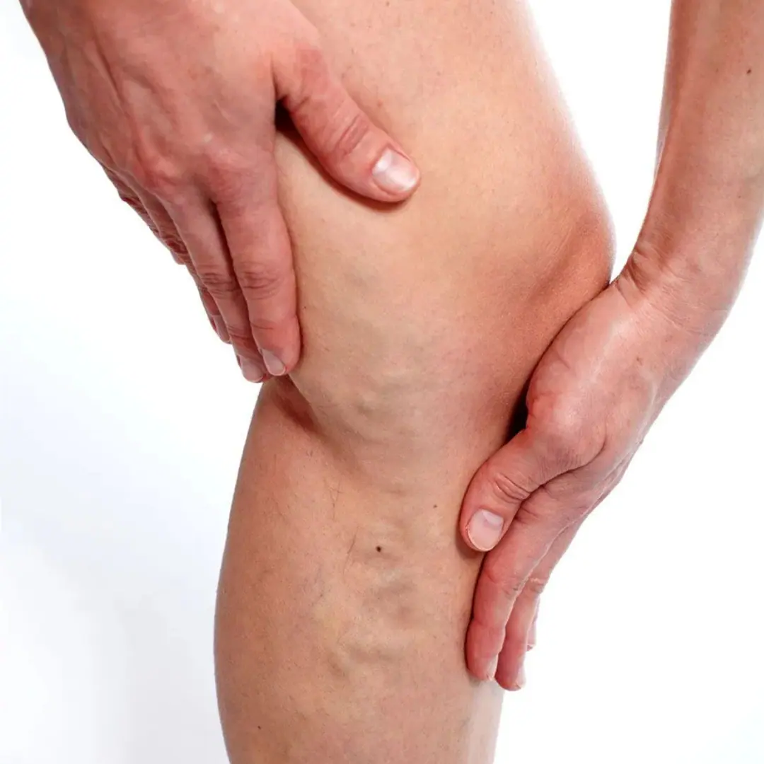 Itching around the affected veins