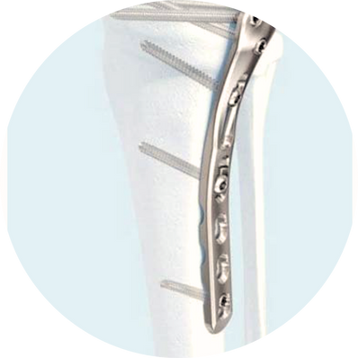 Locking Compression Plate (LCP)