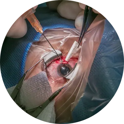 Extracapsular Cataract Extraction