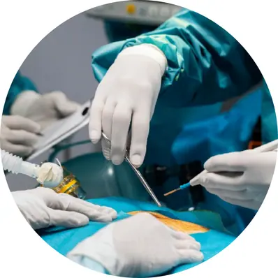 Laser Circumcision