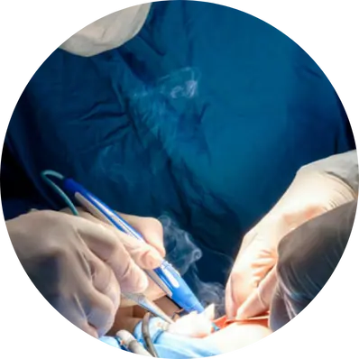 Electrocautery tonsillectomy