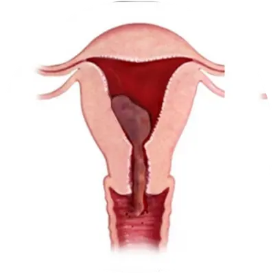 Incomplete miscarriage