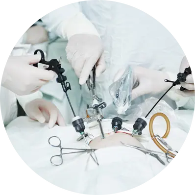 Laparoscopic Cystectomy