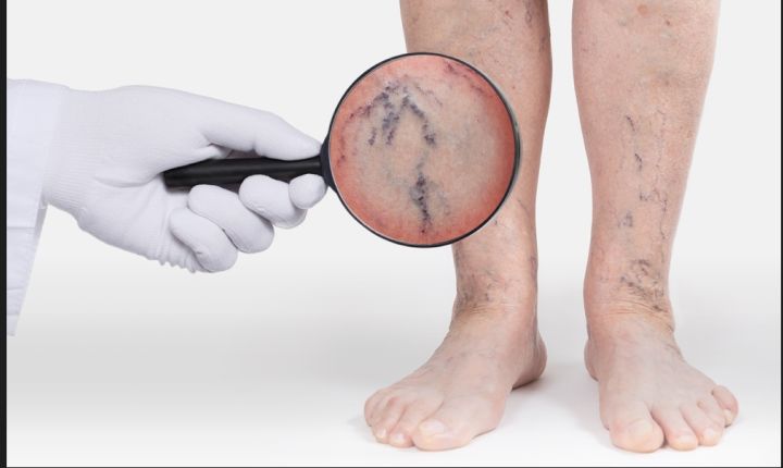 Varicose Veins Laser Treatment (EVLA)