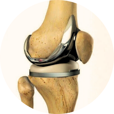 Partial Joint Replacement