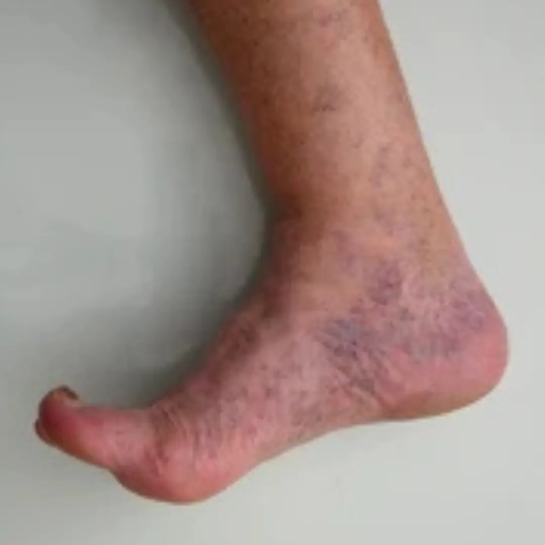 Skin discolorations and ulcers