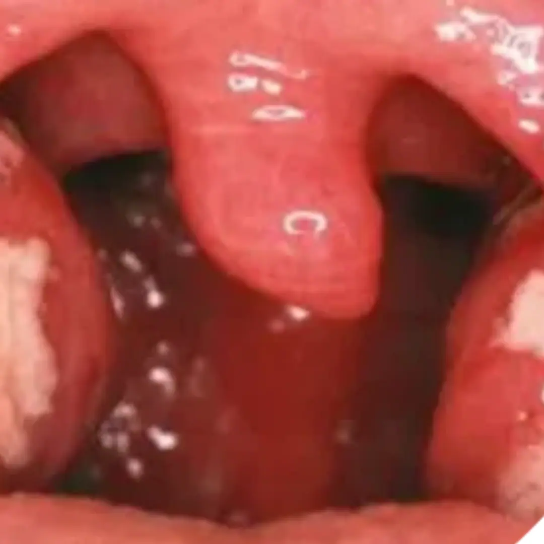 Peritonsillar abscess